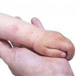 Symptoms and Diagnostics of Atopic Dermatitis