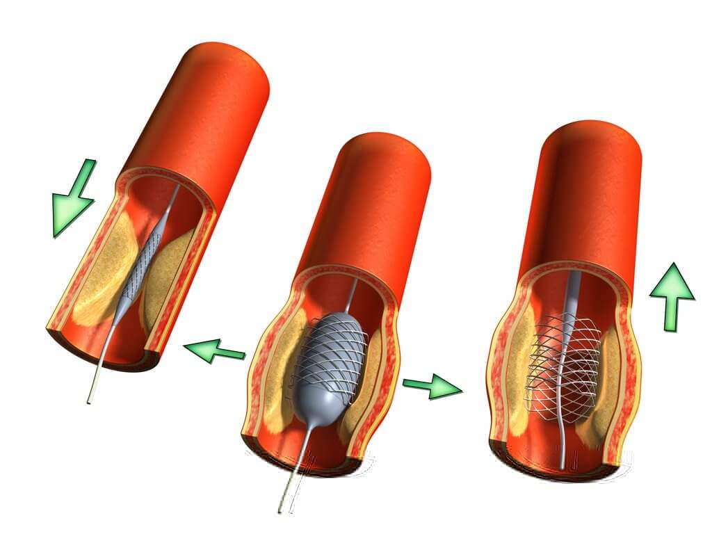 Heart_stent