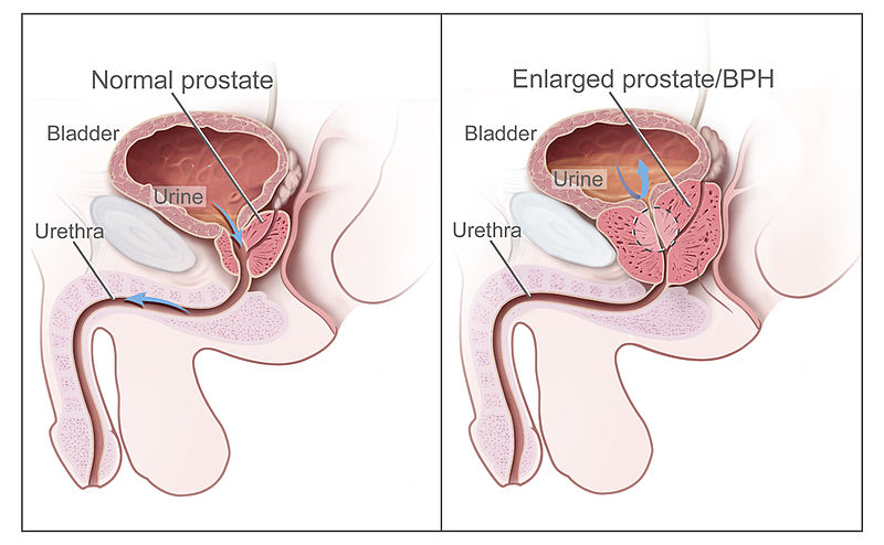 Natural remedies for benign prostatic hyperplasia