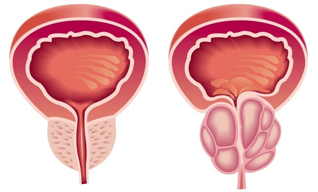 benign prostatic hypertrophy