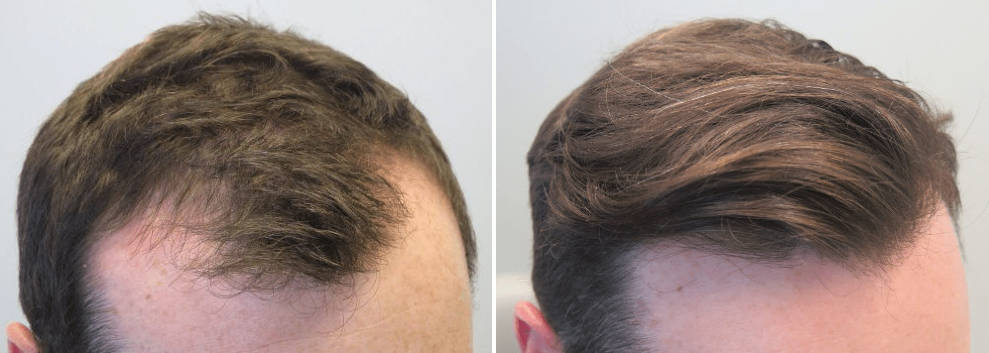 Propecia for baldness